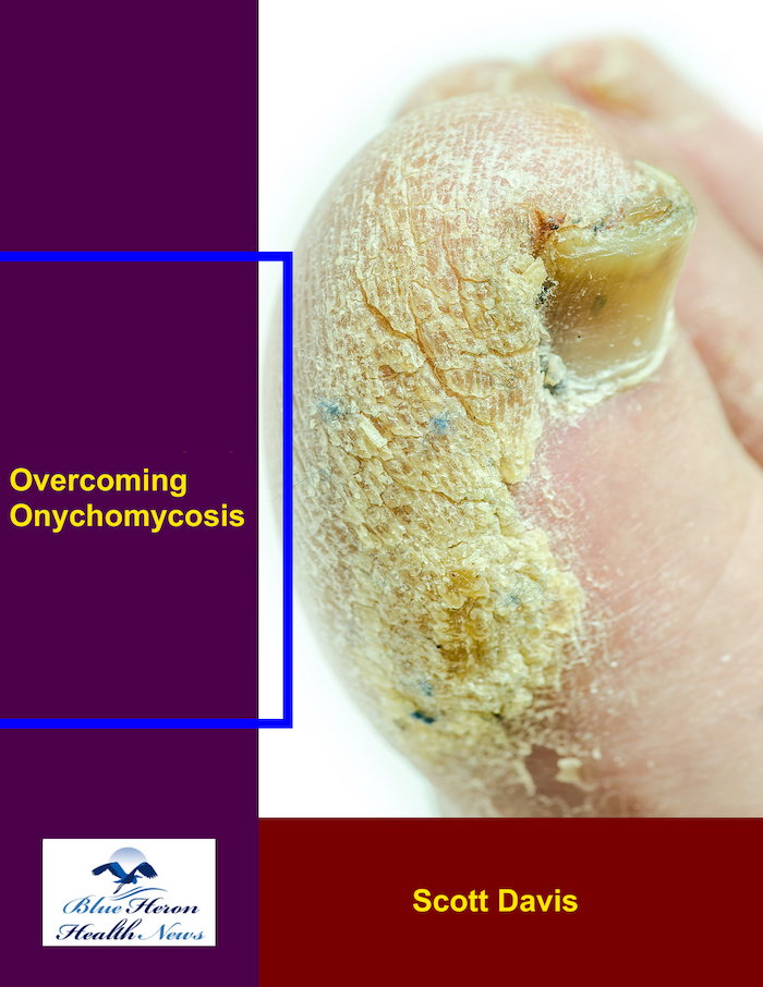 Overcoming Onychomycosis Book